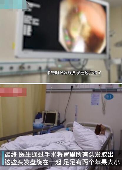 女童吃头发2年塞满胃部是怎么回事?什么情况?终于真相了,原来是这样! 