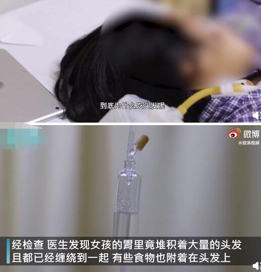 女童吃头发2年塞满胃部是怎么回事?什么情况?终于真相了,原来是这样! 