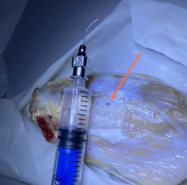 太有才了！浙江这位用“鸡翅膀”研究最佳缝合方案的医生火了